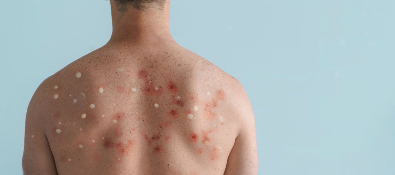 Outbreak Anxiety: Monkeypox Anxiety In A Post-COVID World